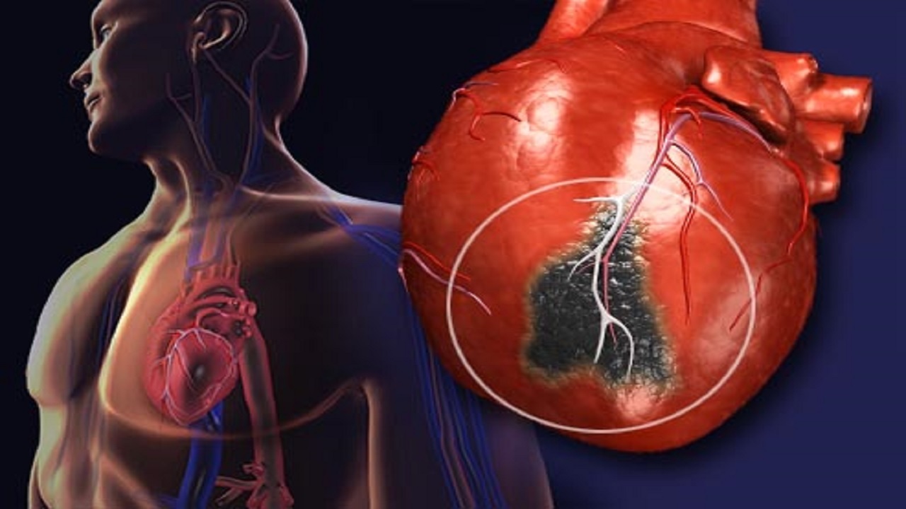 علائم سکته قلبی + چه افرادی در معرض خطر سکته قلبی هستند؟