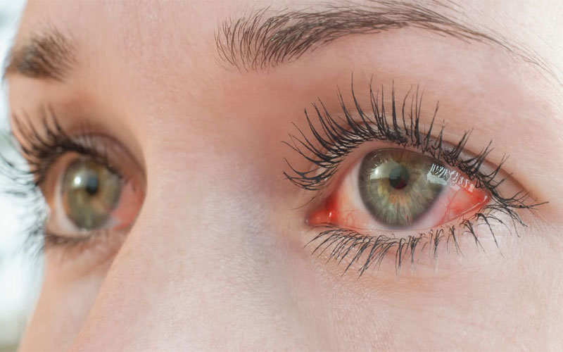علت و دلیل قرمزی چشم + درمان قرمزی چشم چیست؟
